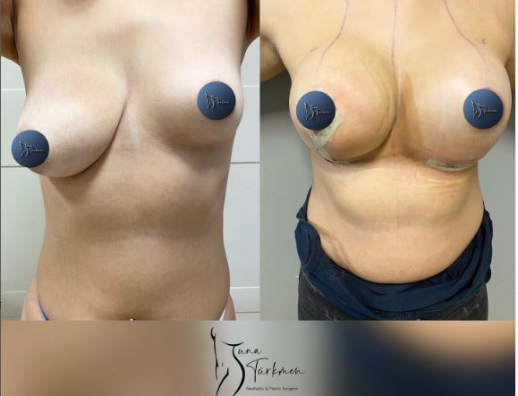 Breast Asymmetry Correction-istanbul-turkey